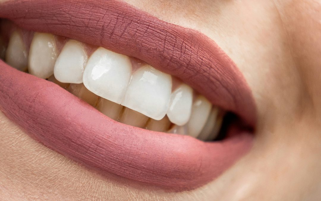 Blanqueamiento Dental: Mitos y Realidades